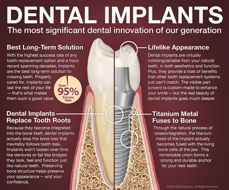 Information about Dental implants in Lakeville, MN